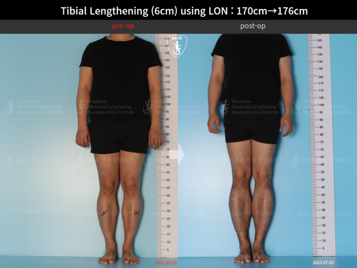 Tibial lengthening, 6 cm gained
