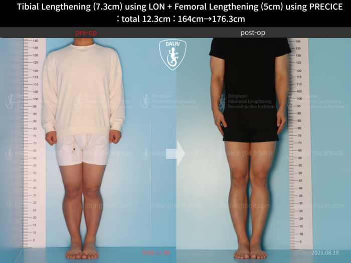 Femoral + tibial lengthening, 7.3 cm gained