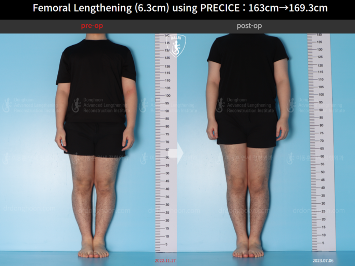 ยืดกระดูกต้นขา เพิ่มขึ้น 6.3 ซม.