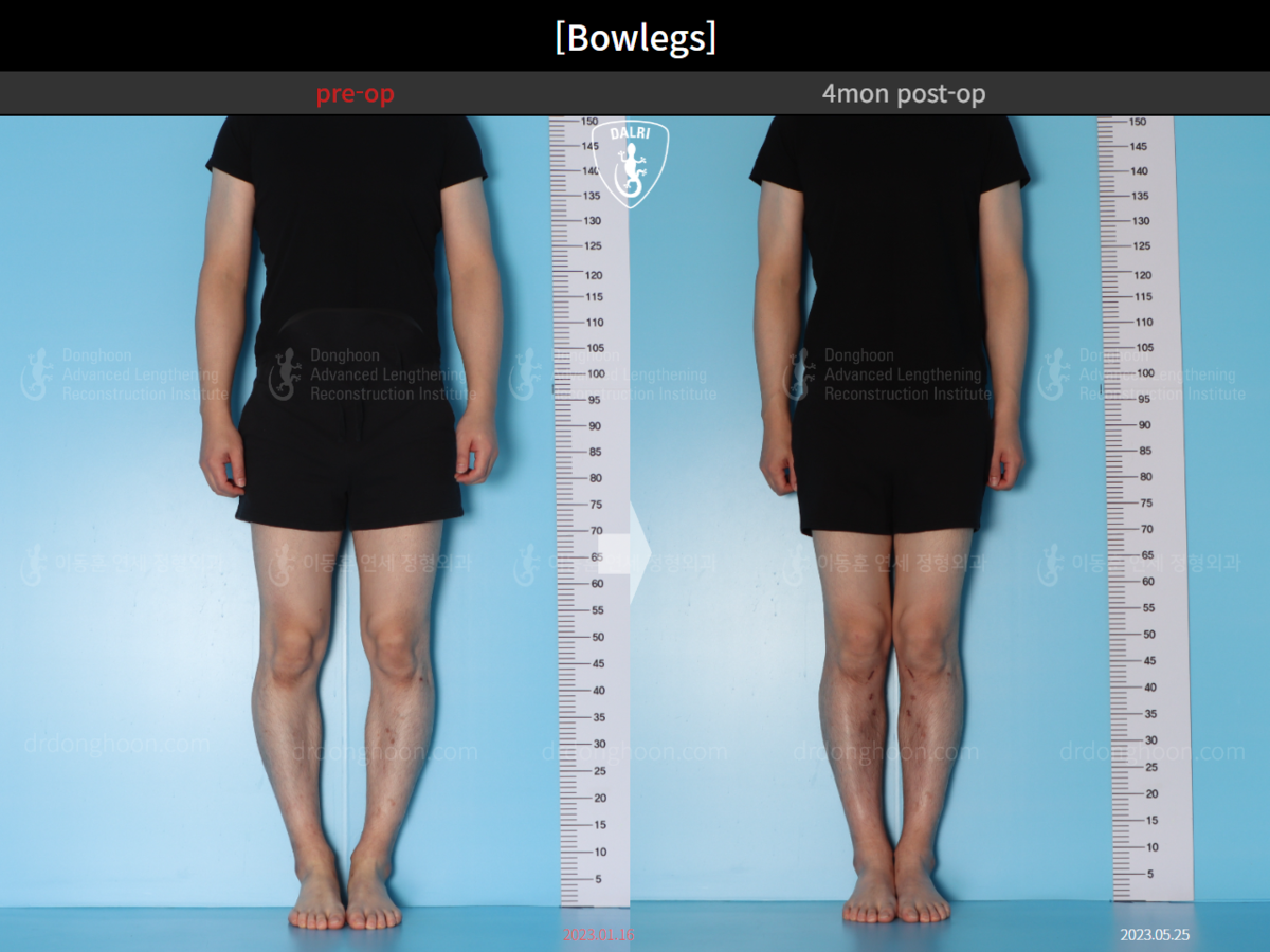 [Bowlegs] 4mon postop Adult Bowlegs