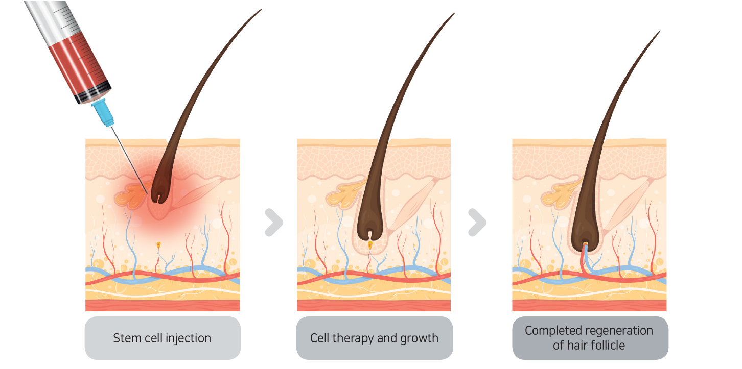 Stem cell jinjection for hair loss