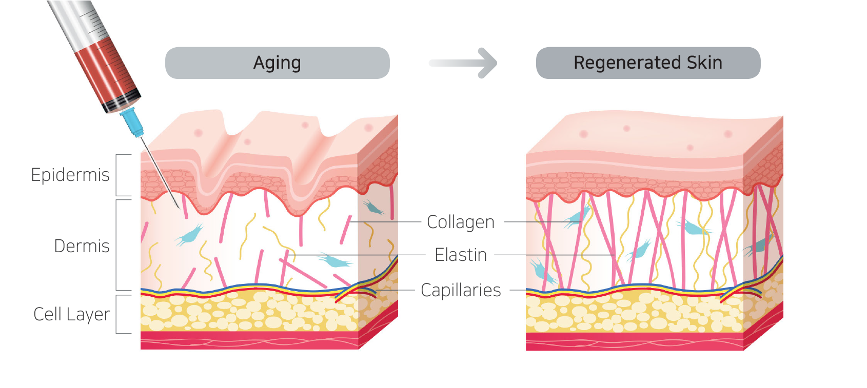 Skin Stem Cell injection