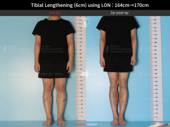 Tibial lengthening, 6 cm gained