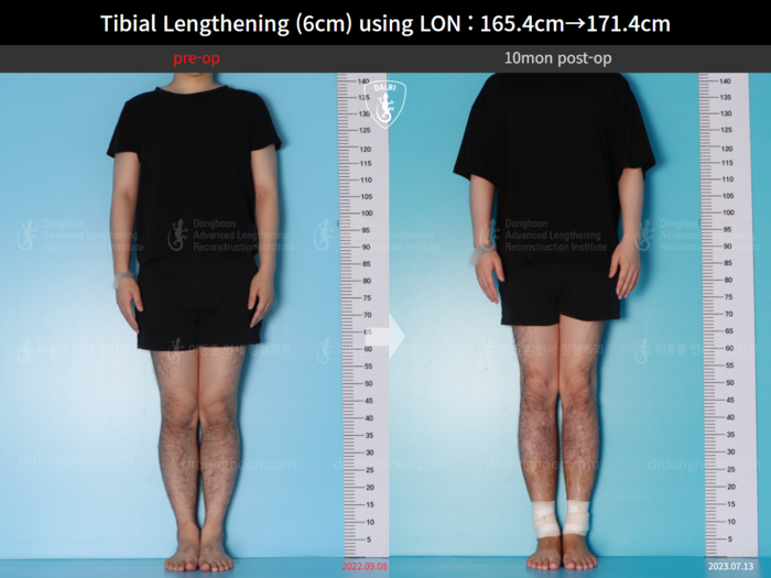 Tibial lengthening, 6 cm gained