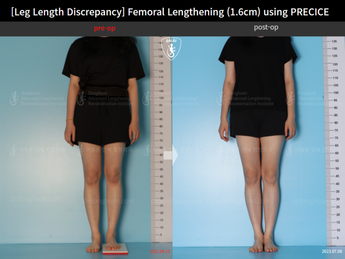 ยืดกระดูกต้นขา เพิ่มขึ้น 1.6 ซม.