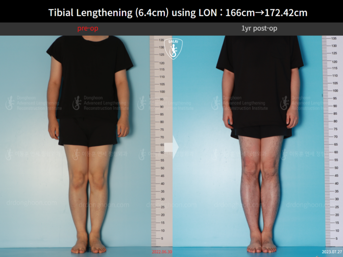 Tibial lengthening, 6.4 cm gained