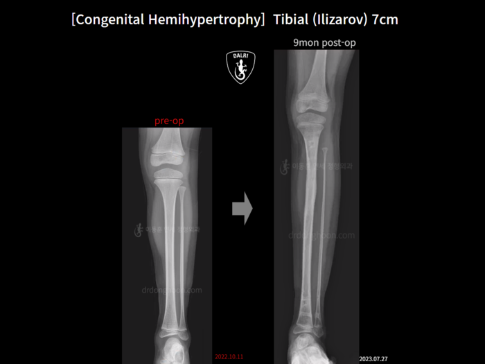 Tibial lengthening