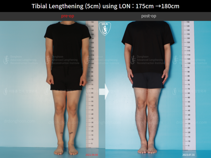 Tibial lengthening, 5 cm gained