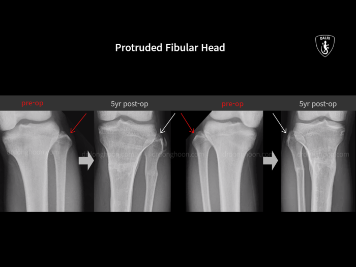 Congenital & paediatric conditions before and after radiograph example 1