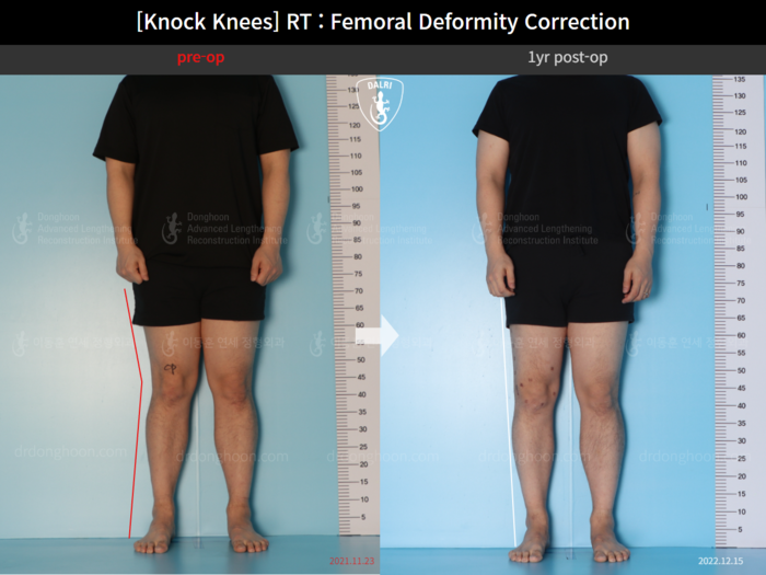 [Knock Knees] RT : Femoral Deformity Correction : 1yr post op + Scars