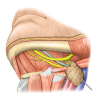 Submandibular gland injection : INFOGRAPHY (인포그라피)
