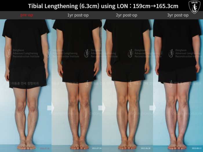Tibial lengthening, 6.3 cm gained