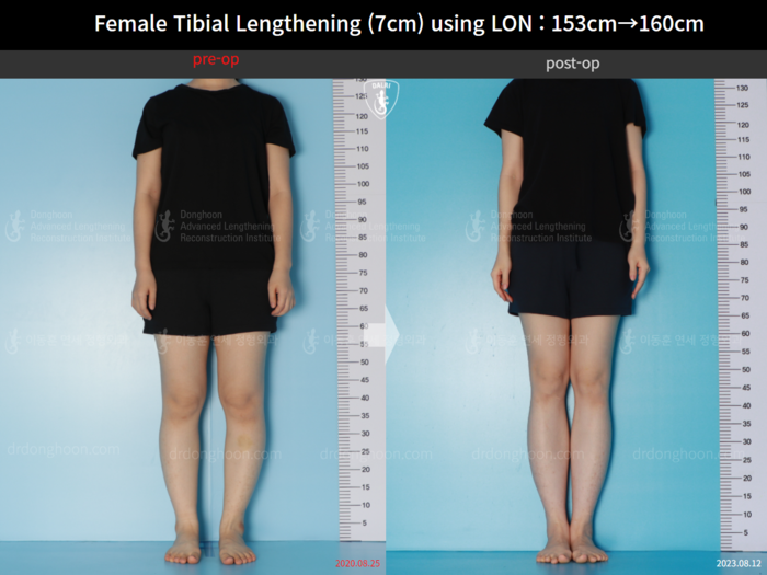 Tibial lengthening, 7 cm gained