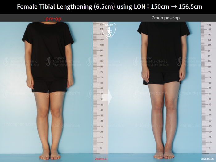 Tibial lengthening, 6.5 cm gained