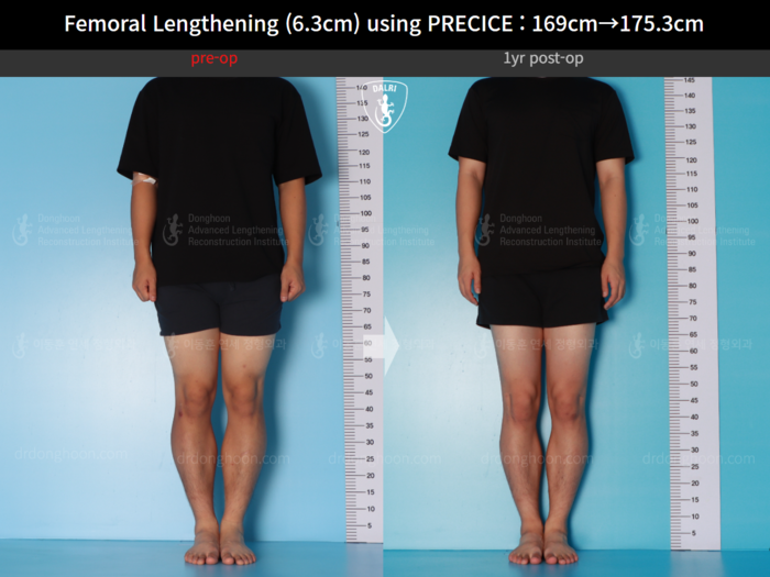 ยืดกระดูกต้นขา เพิ่มขึ้น 6.3 ซม.