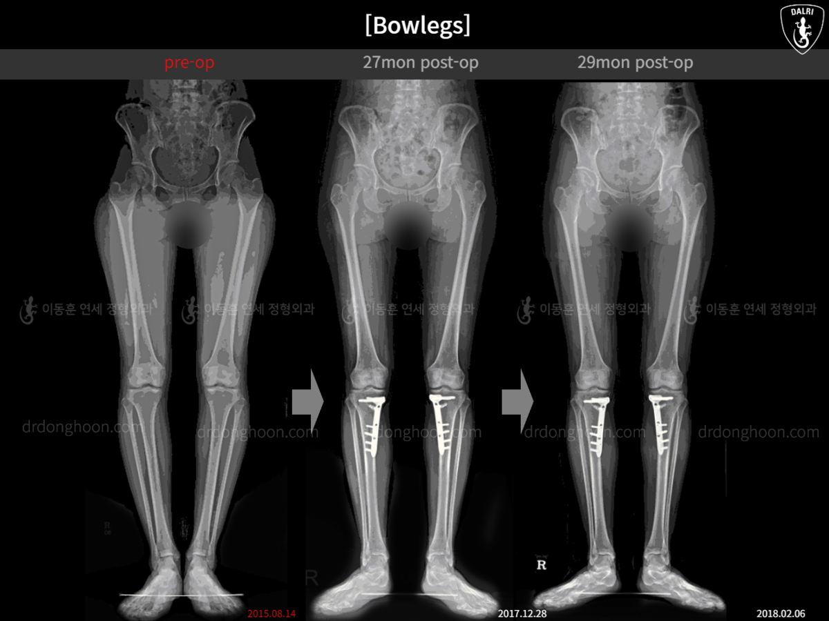 [Bowlegs] 29mon postop Adult Bowlegs