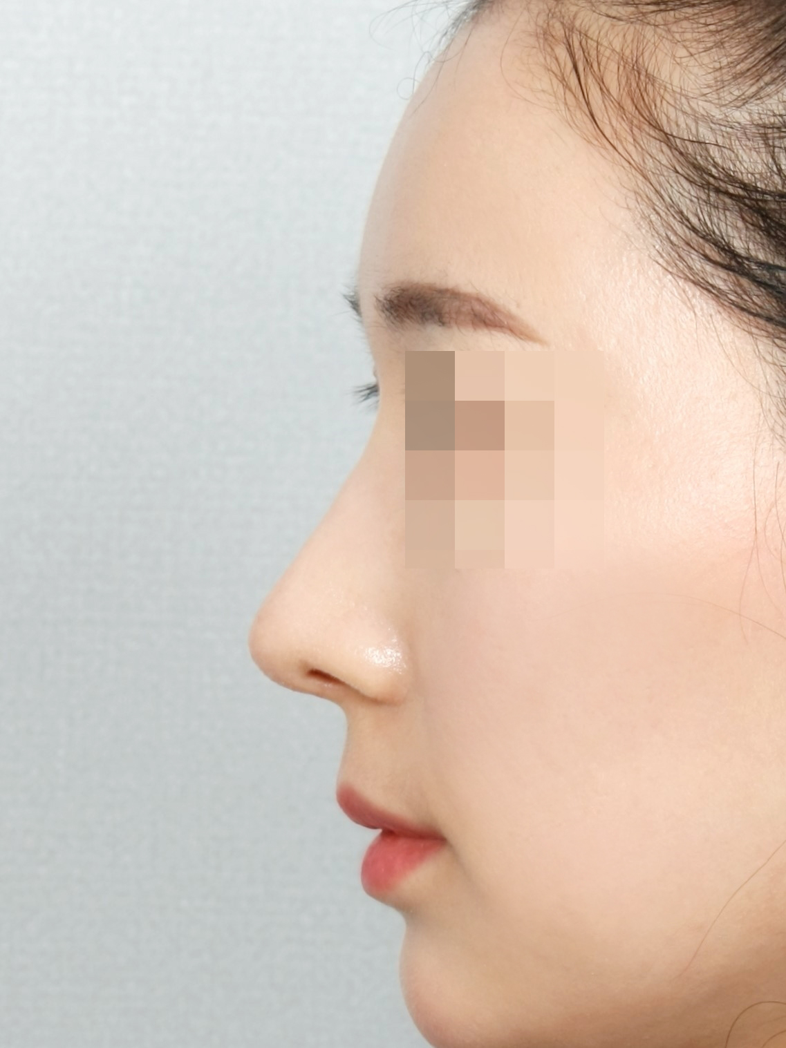 수술 후