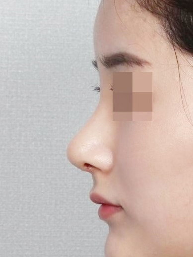 수술 후