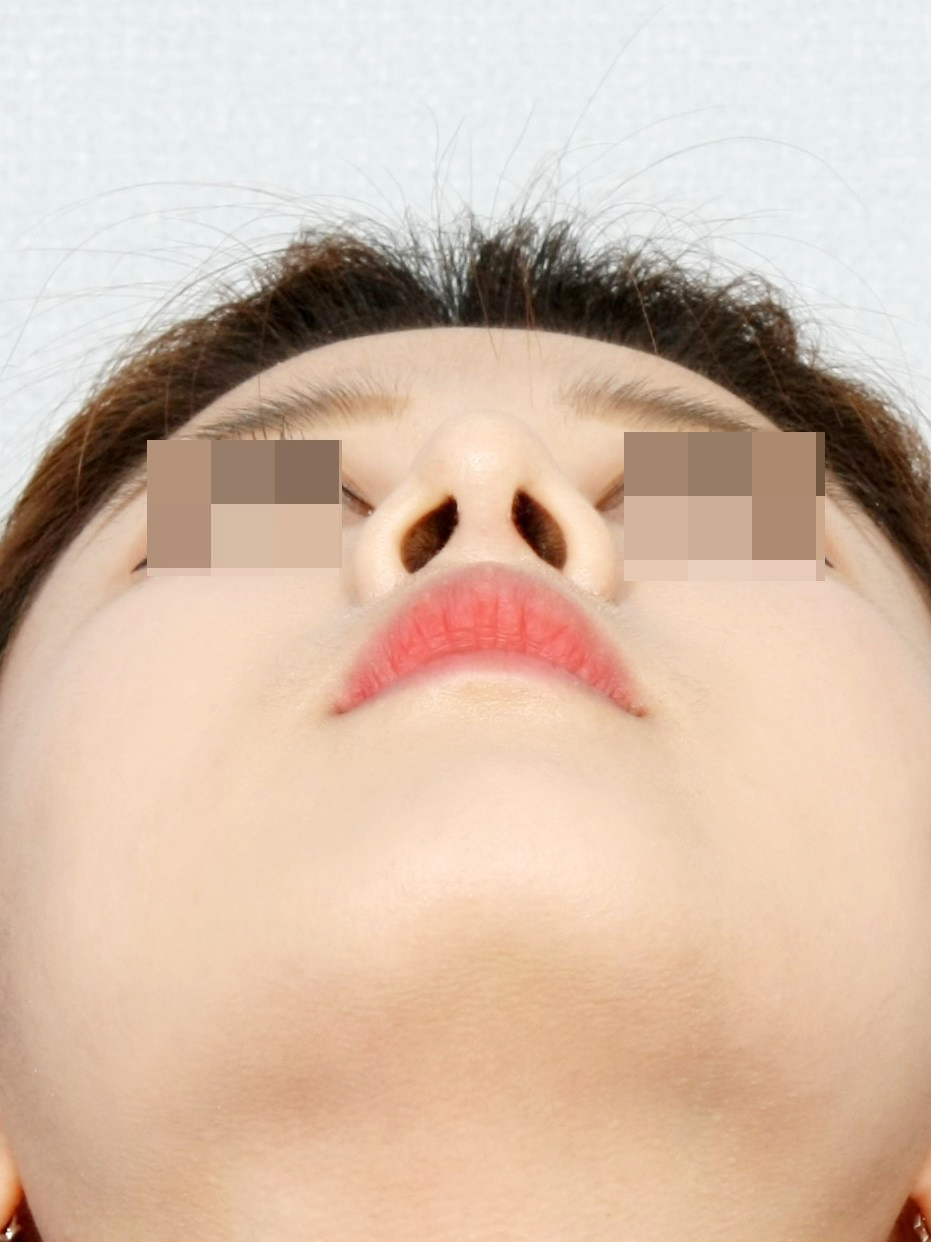 수술 후