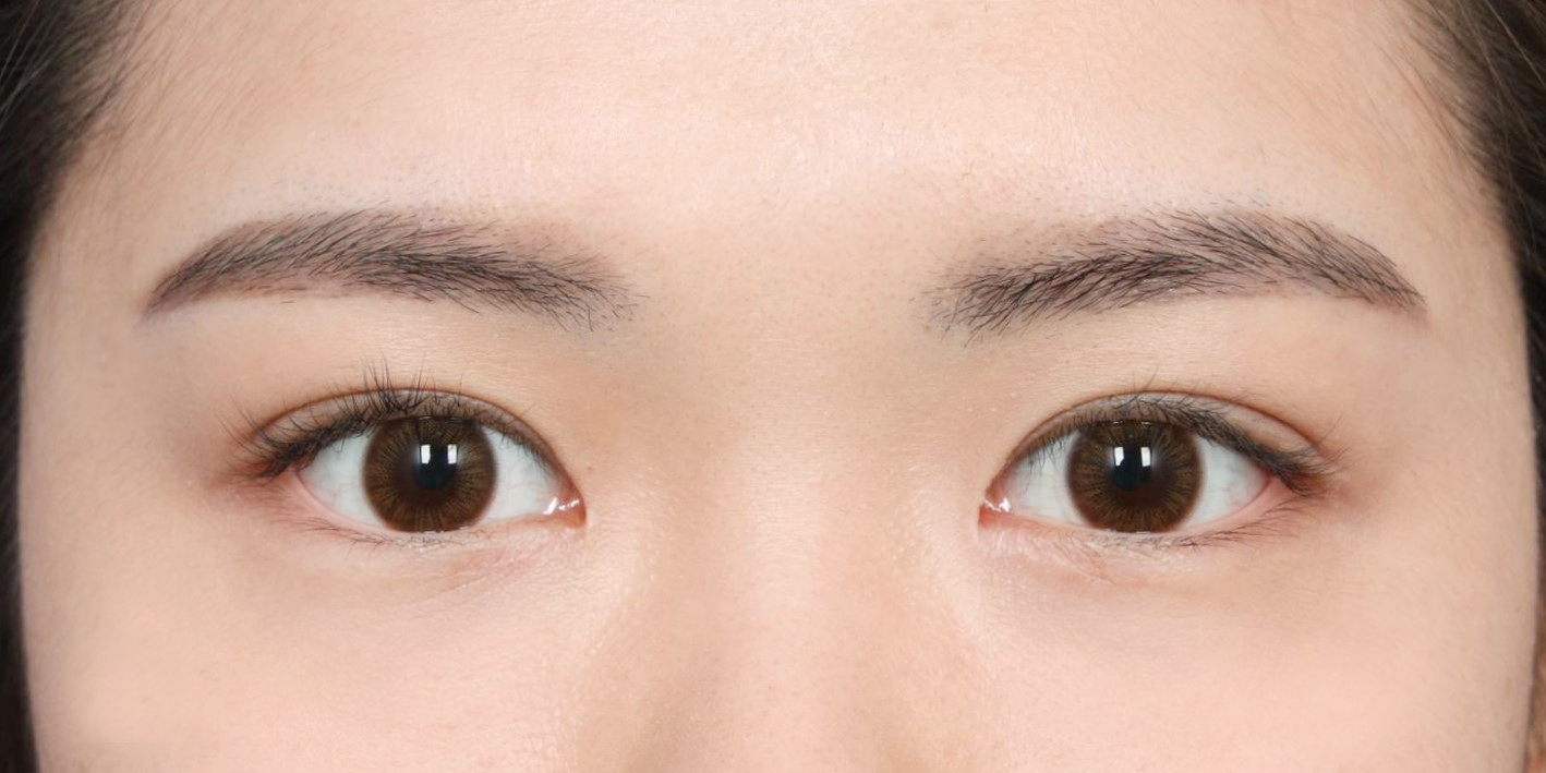 수술 후