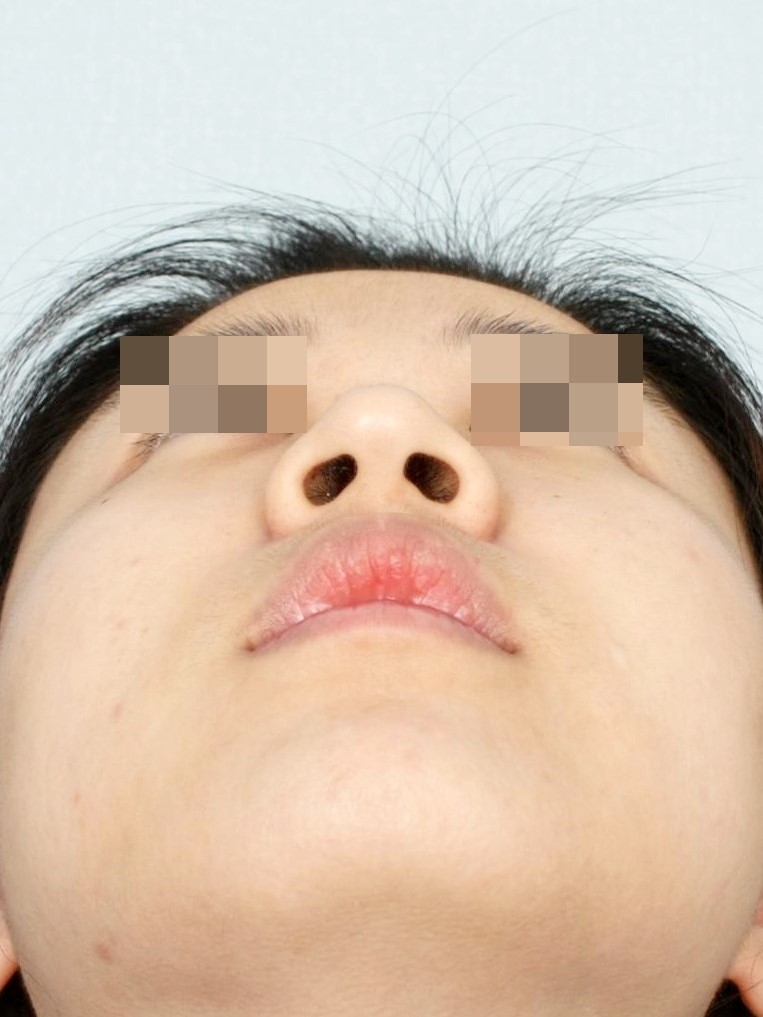 수술 전