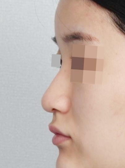수술 전