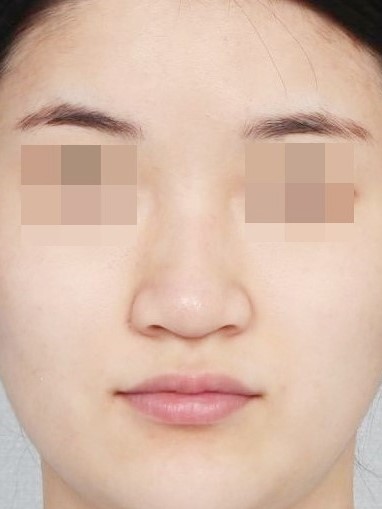 수술 전