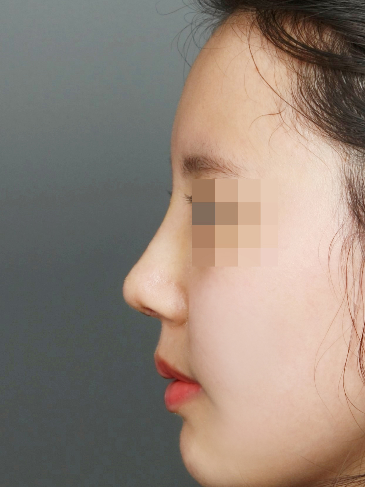 수술 후