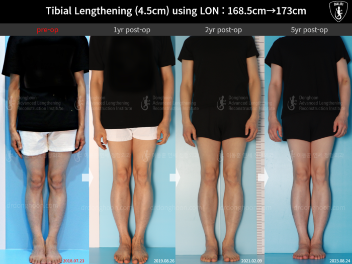 Tibial lengthening, 4.5 cm gained