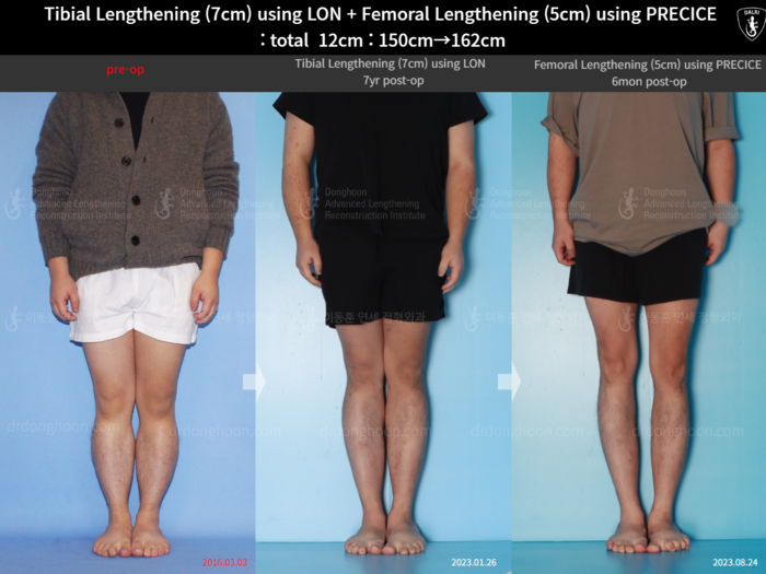 Femoral + tibial lengthening, 7 cm gained