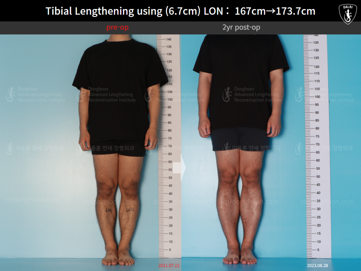 Tibial Lengthening Using (6.7cm) LON : 167cm→173.7cm : 2yr Post-op ...