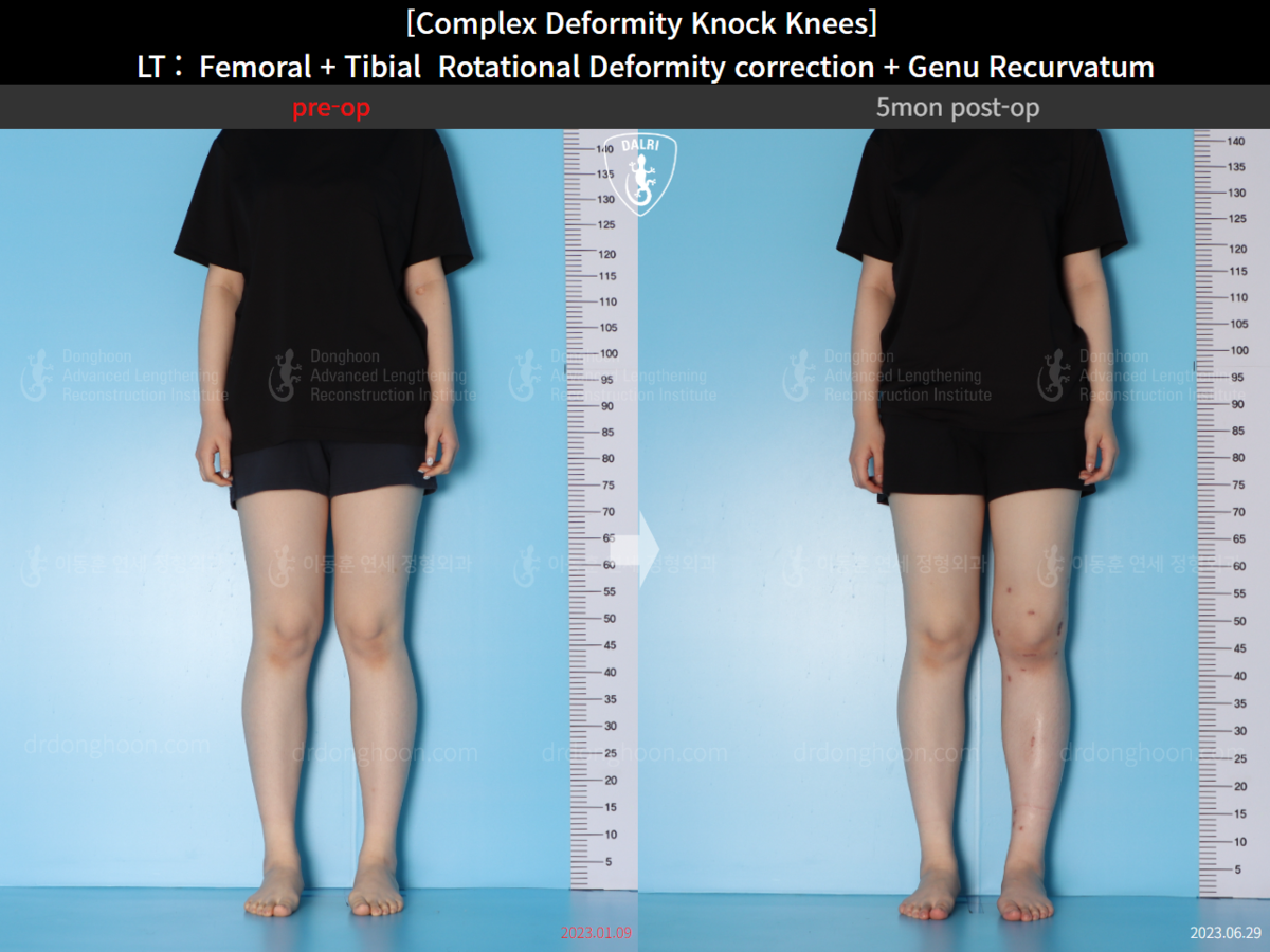 [Complex Deformity Knock Knees] LT : Femoral + Tibial Rotational ...