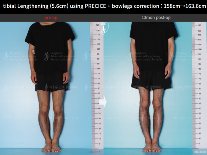 ยืดกระดูกหน้าแข้ง เพิ่มขึ้น 5.6 ซม.