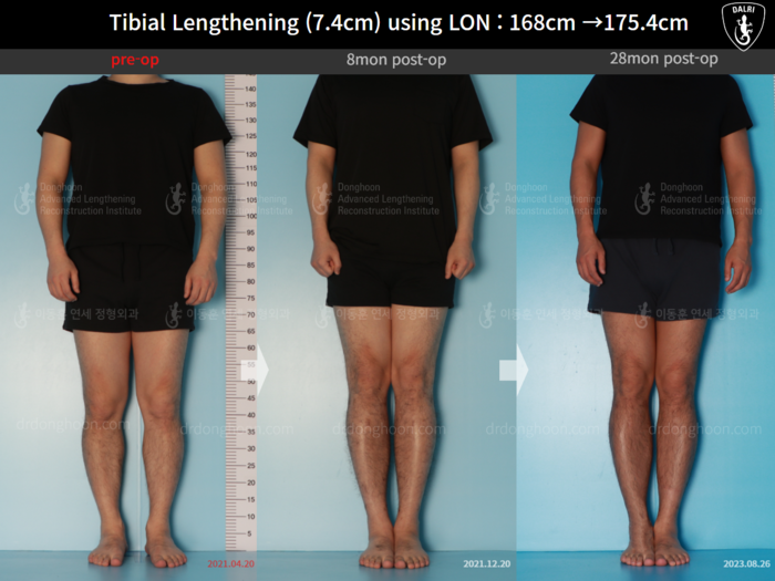 Tibial lengthening, 7.4 cm gained
