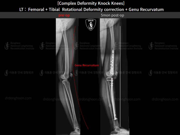 Femoral + tibial lengthening