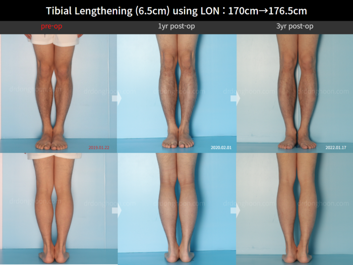 Tibial lengthening, 6.5 cm gained