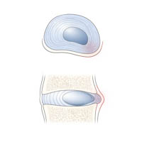 Disk injury (herination 1) : INFOGRAPHY (인포그라피)