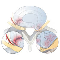 Disk injury : INFOGRAPHY (인포그라피)