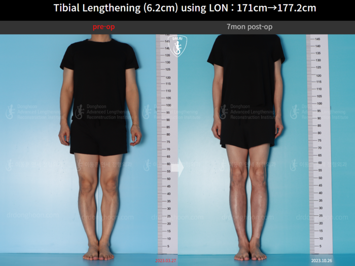 Tibial lengthening, 6.2 cm gained