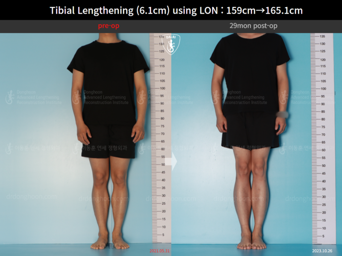 Tibial lengthening, 6.1 cm gained