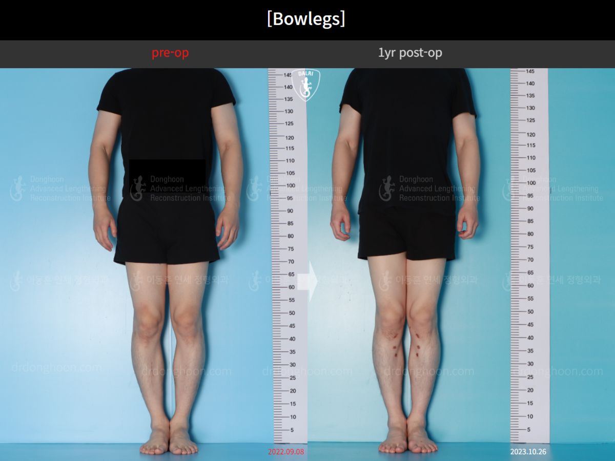 [Bowlegs] 1yr postop +Scars Adult Bowlegs