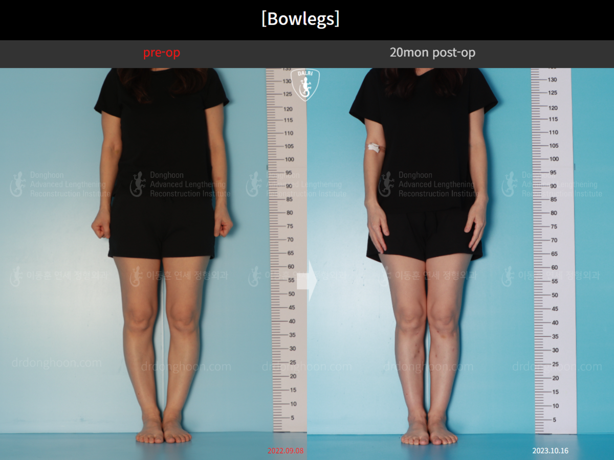 [Bowlegs] 20mon postop+Scars Adult Bowlegs