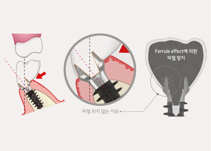 <p style="margin-left:10px;">POINT3</p><h5 style="margin-left:10px"><B>강한보철구조, 나사 풀림 및 파절 없음</B></h5>
