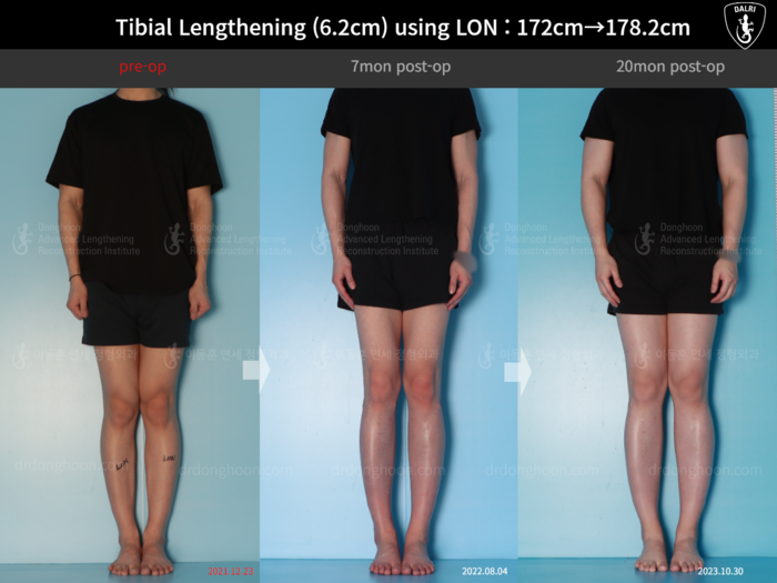 Tibial lengthening, 6.2 cm gained