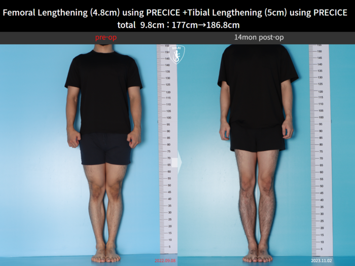 Femoral + tibial lengthening, 4.8 cm gained