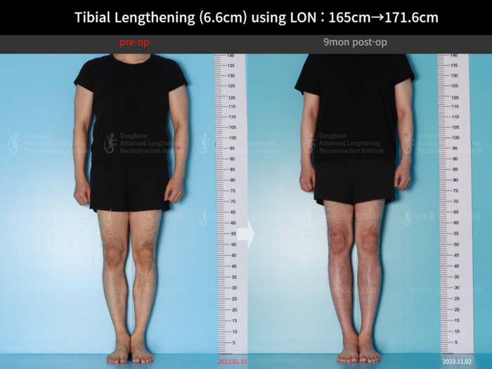 Tibial lengthening, 6.6 cm gained
