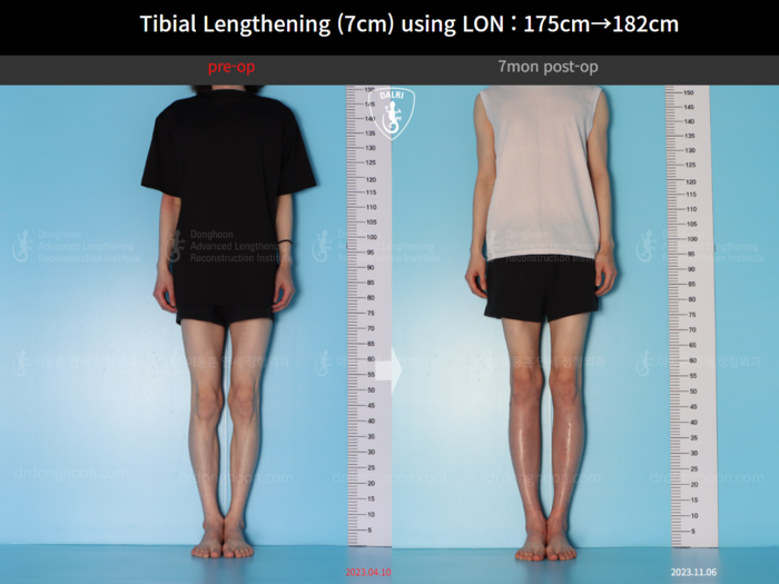 Tibial lengthening, 7 cm gained