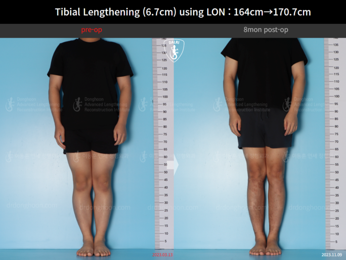 Tibial lengthening, 6.7 cm gained