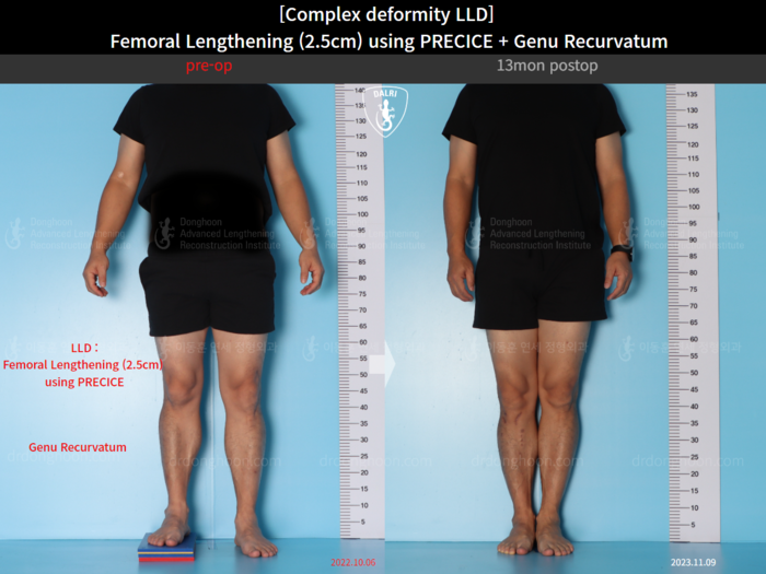 ยืดกระดูกต้นขา เพิ่มขึ้น 2.5 ซม.