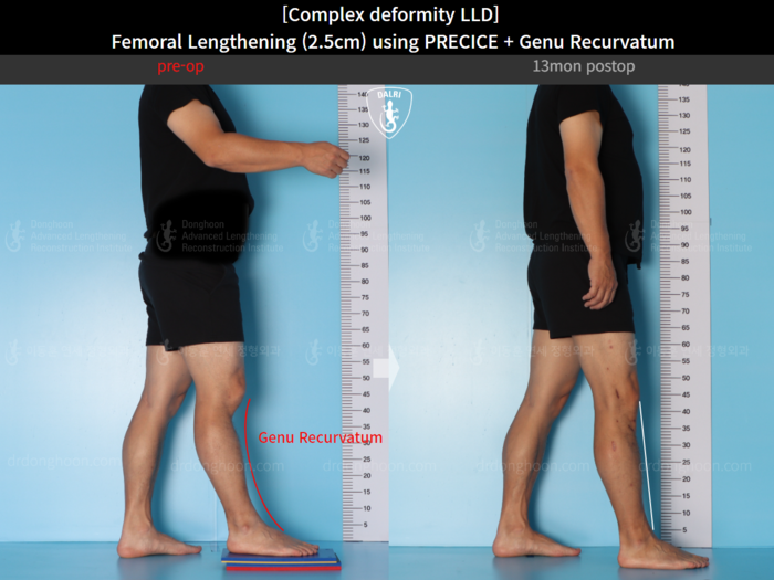 Femoral lengthening, 2.5 cm gained